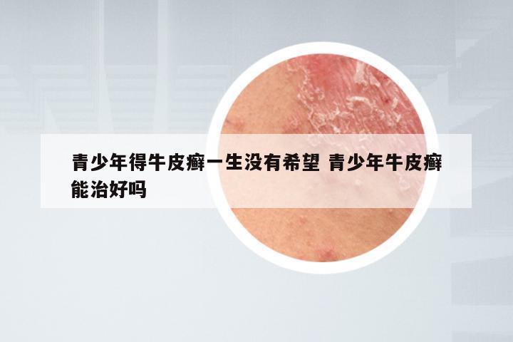 青少年得牛皮癣一生没有希望 青少年牛皮癣能治好吗