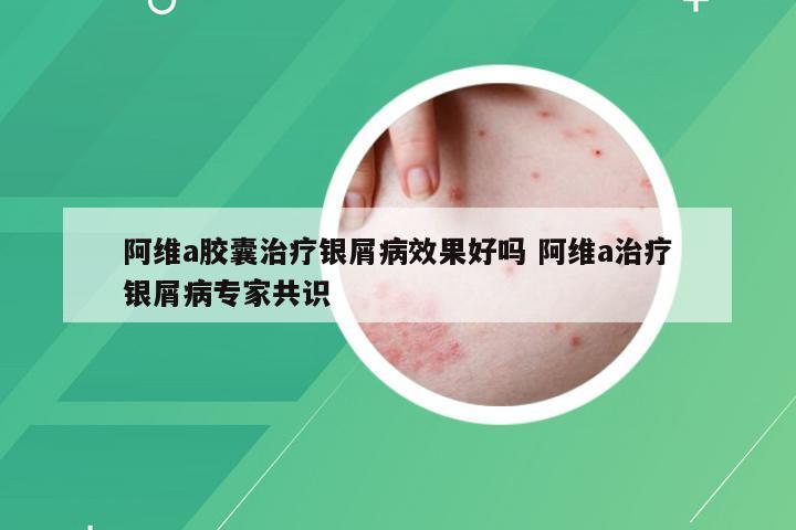 阿维a胶囊治疗银屑病效果好吗 阿维a治疗银屑病专家共识