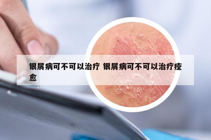 银屑病可不可以治疗 银屑病可不可以治疗痊愈