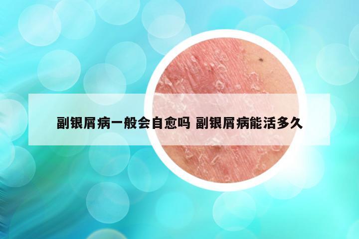 副银屑病一般会自愈吗 副银屑病能活多久