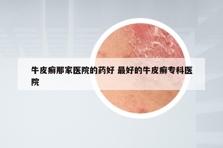 牛皮癣那家医院的药好 最好的牛皮癣专科医院