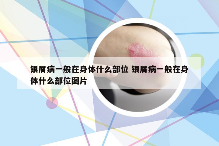 银屑病一般在身体什么部位 银屑病一般在身体什么部位图片