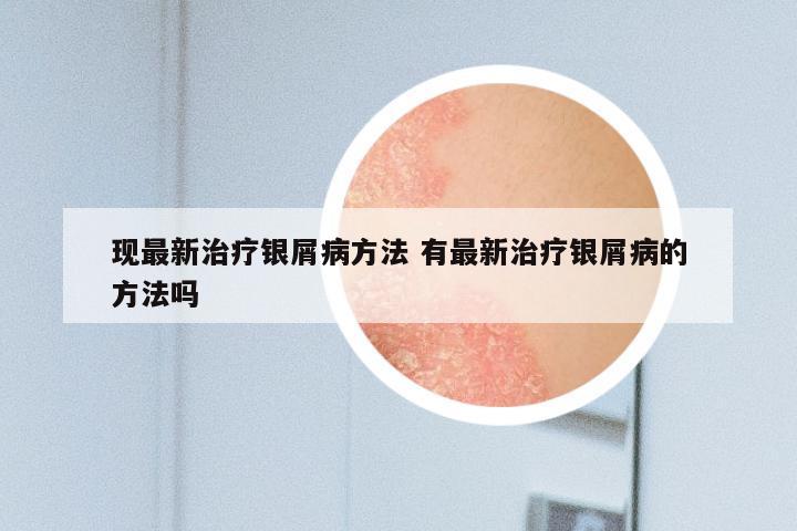 现最新治疗银屑病方法 有最新治疗银屑病的方法吗