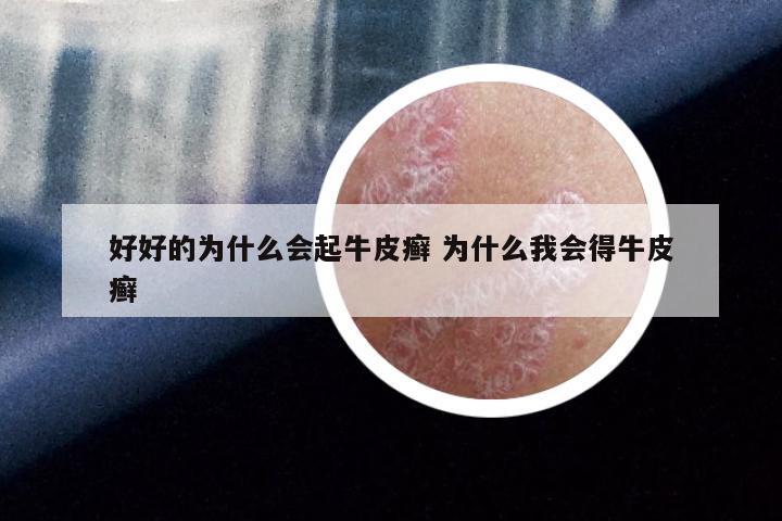 好好的为什么会起牛皮癣 为什么我会得牛皮癣