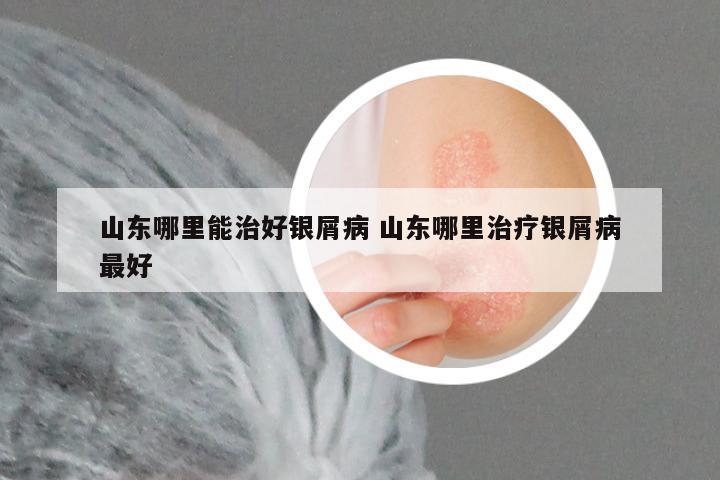 山东哪里能治好银屑病 山东哪里治疗银屑病最好