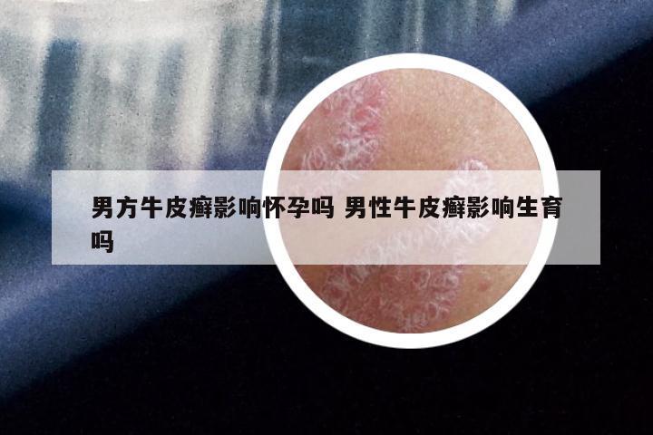 男方牛皮癣影响怀孕吗 男性牛皮癣影响生育吗