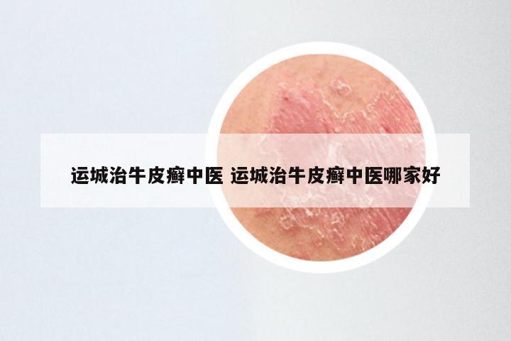 运城治牛皮癣中医 运城治牛皮癣中医哪家好