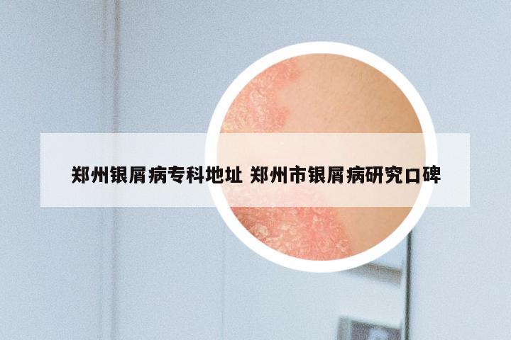 郑州银屑病专科地址 郑州市银屑病研究口碑