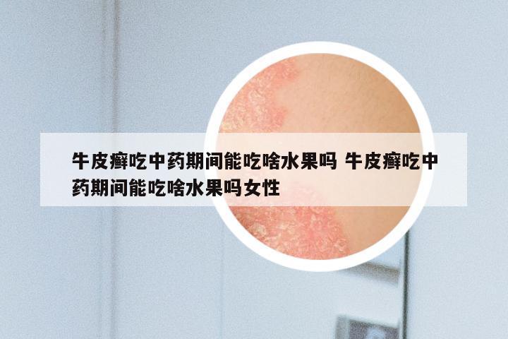 牛皮癣吃中药期间能吃啥水果吗 牛皮癣吃中药期间能吃啥水果吗女性