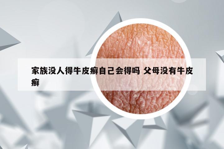 家族没人得牛皮癣自己会得吗 父母没有牛皮癣