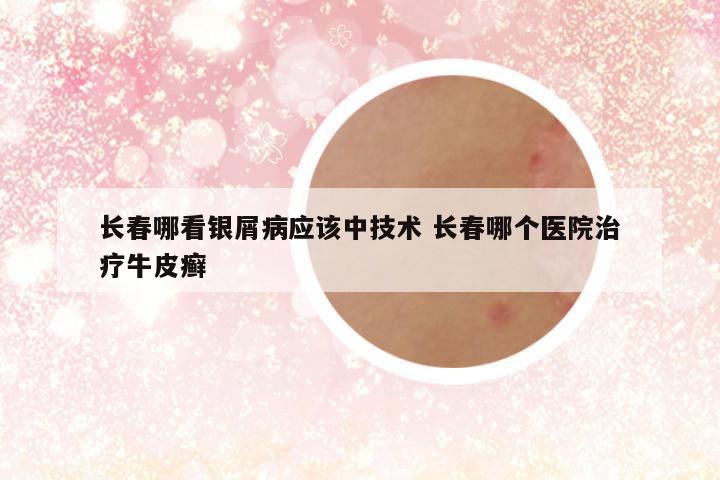 长春哪看银屑病应该中技术 长春哪个医院治疗牛皮癣