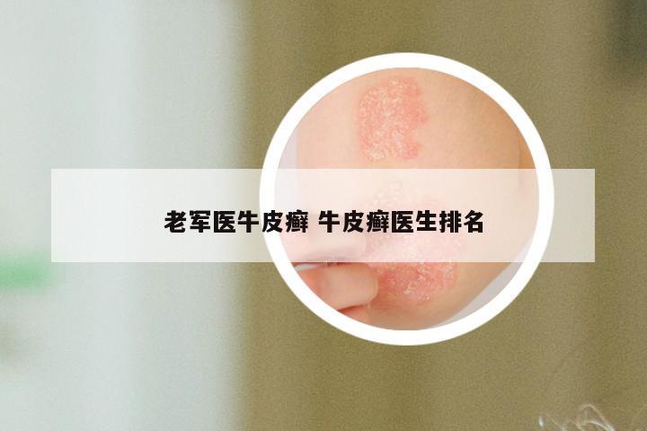 老军医牛皮癣 牛皮癣医生排名