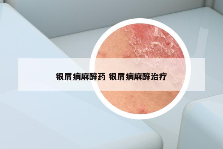 银屑病麻醉药 银屑病麻醉治疗