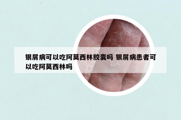 银屑病可以吃阿莫西林胶囊吗 银屑病患者可以吃阿莫西林吗