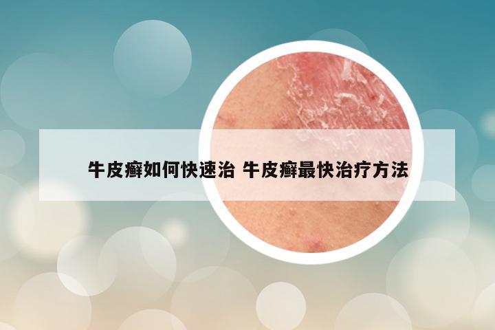 牛皮癣如何快速治 牛皮癣最快治疗方法