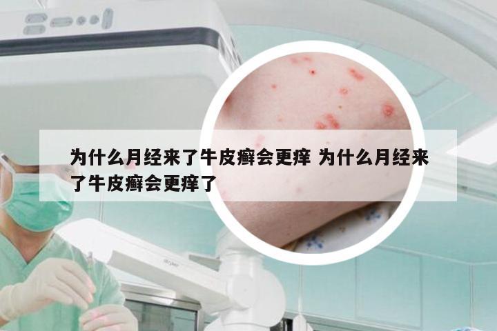 为什么月经来了牛皮癣会更痒 为什么月经来了牛皮癣会更痒了