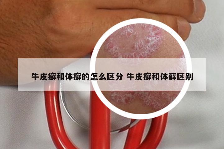 牛皮癣和体癣的怎么区分 牛皮癣和体藓区别