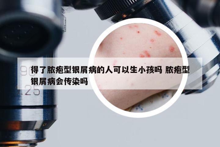 得了脓疱型银屑病的人可以生小孩吗 脓疱型银屑病会传染吗