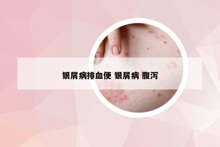 银屑病排血便 银屑病 腹泻