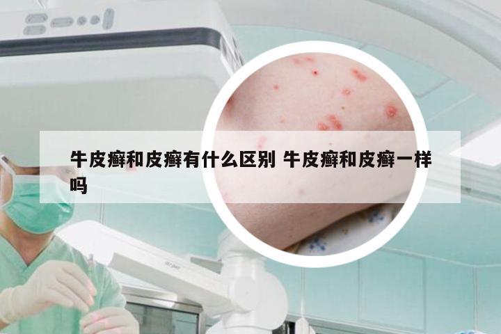 牛皮癣和皮癣有什么区别 牛皮癣和皮癣一样吗