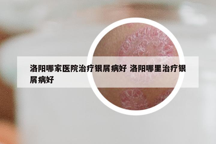 洛阳哪家医院治疗银屑病好 洛阳哪里治疗银屑病好