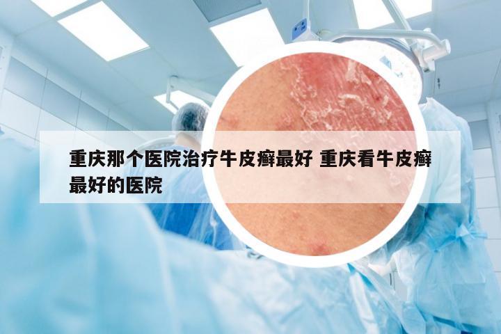 重庆那个医院治疗牛皮癣最好 重庆看牛皮癣最好的医院