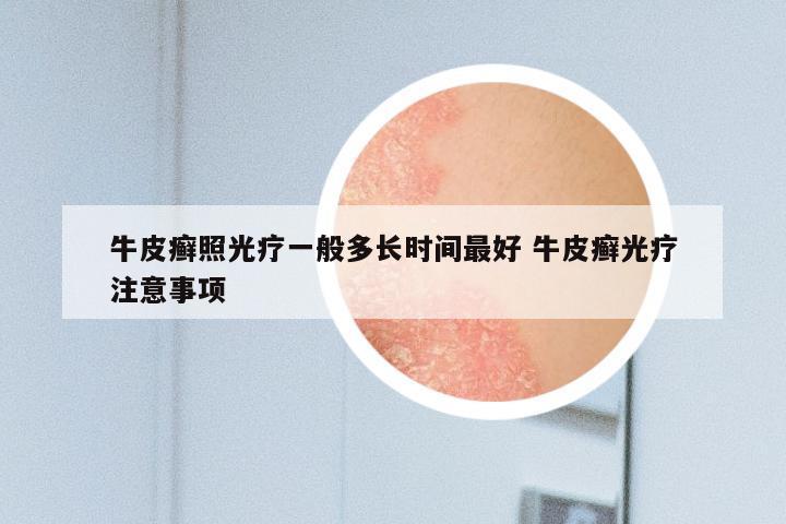 牛皮癣照光疗一般多长时间最好 牛皮癣光疗注意事项