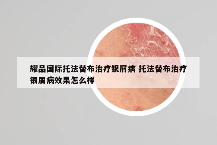 耀品国际托法替布治疗银屑病 托法替布治疗银屑病效果怎么样