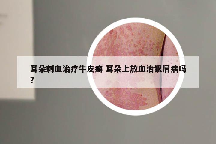 耳朵刺血治疗牛皮癣 耳朵上放血治银屑病吗?
