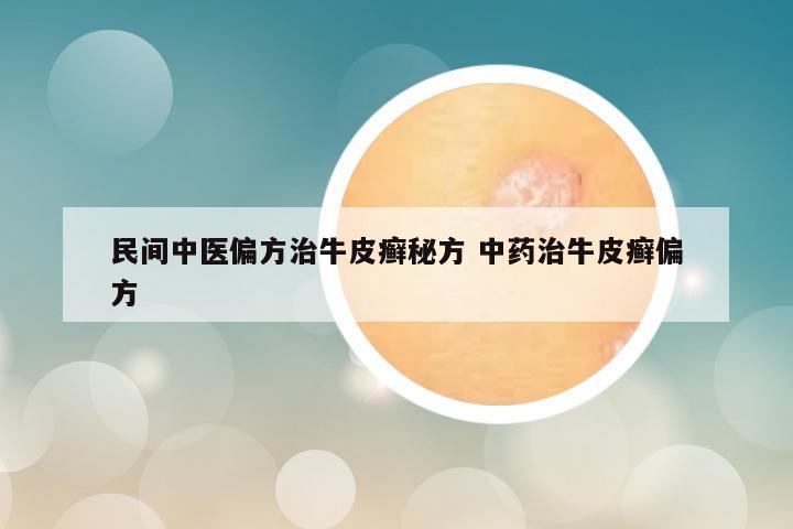 民间中医偏方治牛皮癣秘方 中药治牛皮癣偏方
