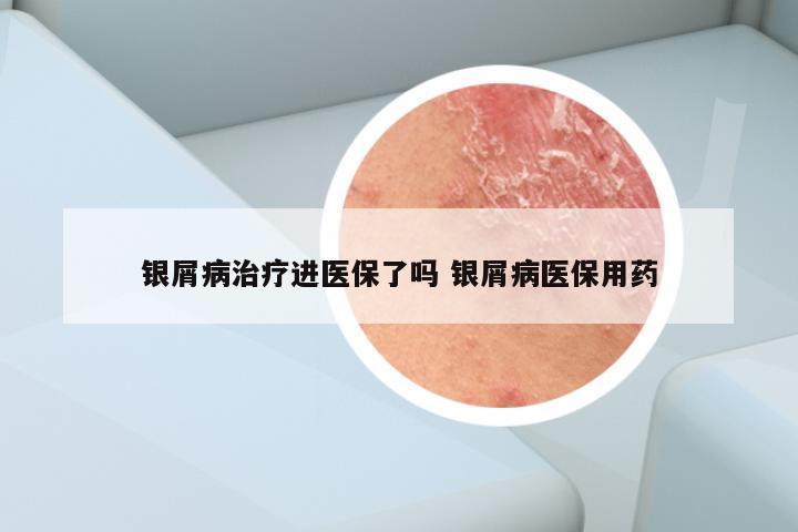 银屑病治疗进医保了吗 银屑病医保用药