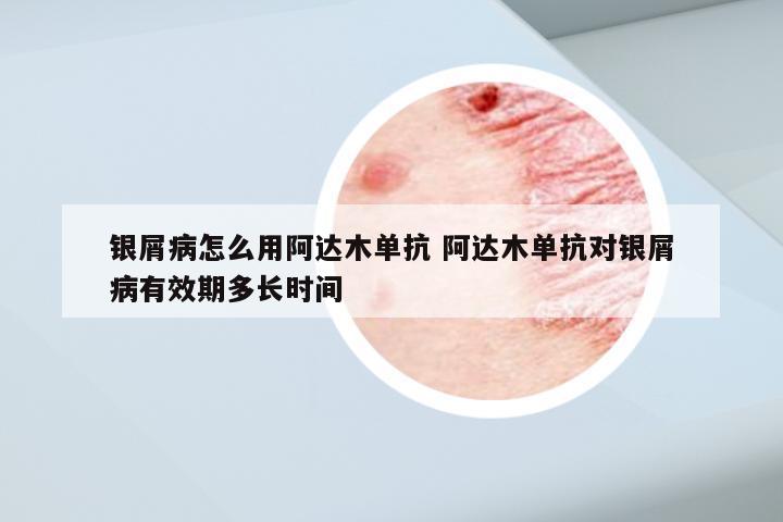 银屑病怎么用阿达木单抗 阿达木单抗对银屑病有效期多长时间