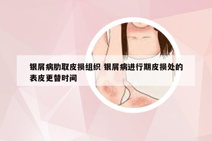 银屑病肋取皮损组织 银屑病进行期皮损处的表皮更替时间