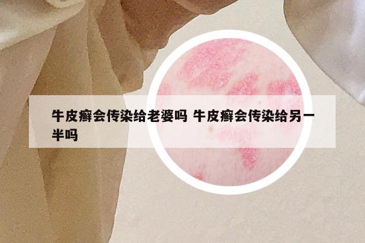 牛皮癣会传染给老婆吗 牛皮癣会传染给另一半吗