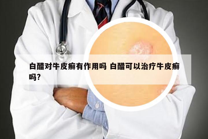 白醋对牛皮癣有作用吗 白醋可以治疗牛皮癣吗?