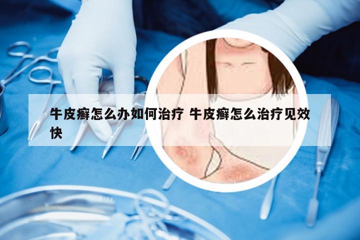 牛皮癣怎么办如何治疗 牛皮癣怎么治疗见效快