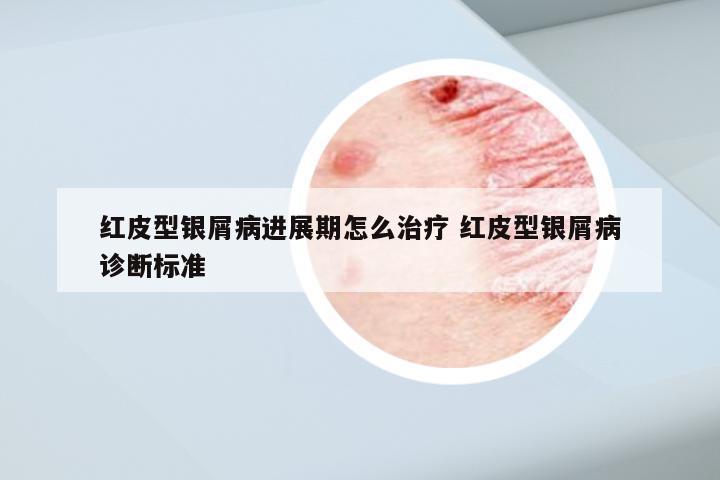 红皮型银屑病进展期怎么治疗 红皮型银屑病诊断标准