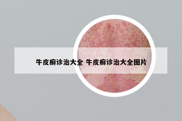 牛皮癣诊治大全 牛皮癣诊治大全图片