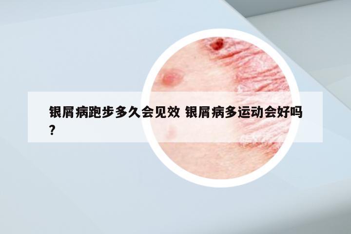 银屑病跑步多久会见效 银屑病多运动会好吗?