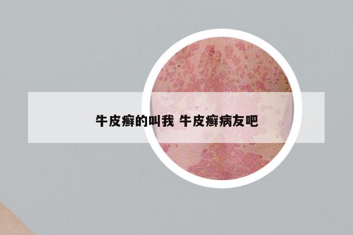 牛皮癣的叫我 牛皮癣病友吧