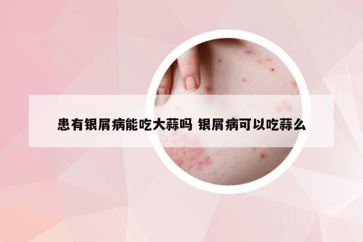 患有银屑病能吃大蒜吗 银屑病可以吃蒜么