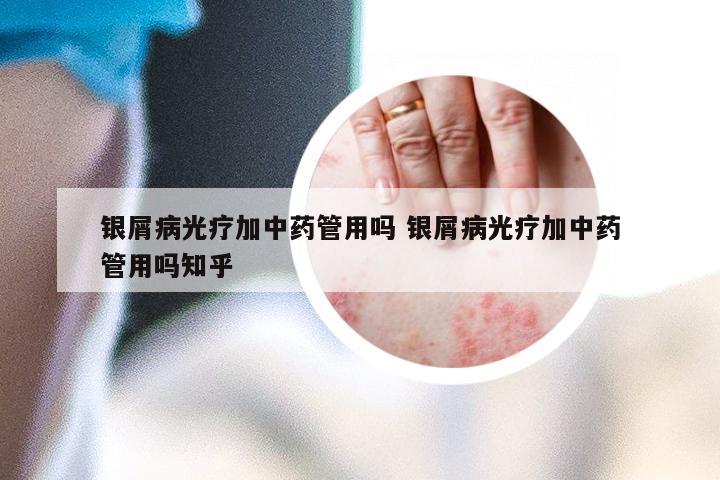 银屑病光疗加中药管用吗 银屑病光疗加中药管用吗知乎
