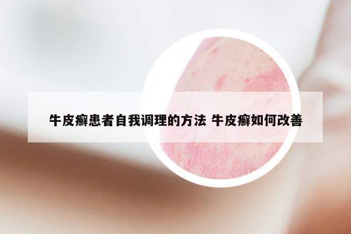 牛皮癣患者自我调理的方法 牛皮癣如何改善