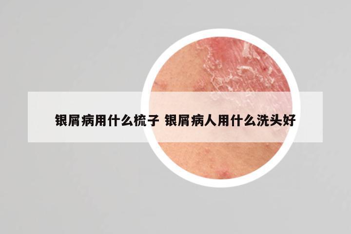银屑病用什么梳子 银屑病人用什么洗头好