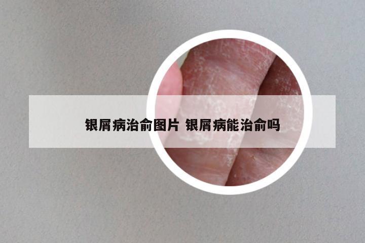 银屑病治俞图片 银屑病能治俞吗