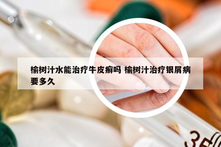 榆树汁水能治疗牛皮癣吗 榆树汁治疗银屑病要多久