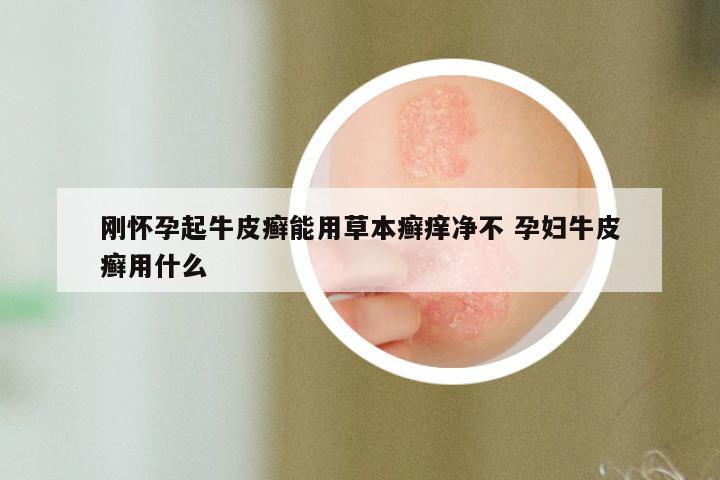刚怀孕起牛皮癣能用草本癣痒净不 孕妇牛皮癣用什么
