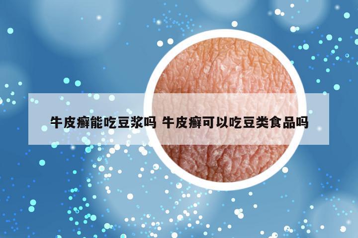 牛皮癣能吃豆浆吗 牛皮癣可以吃豆类食品吗