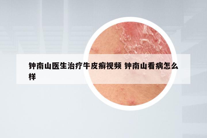 钟南山医生治疗牛皮癣视频 钟南山看病怎么样
