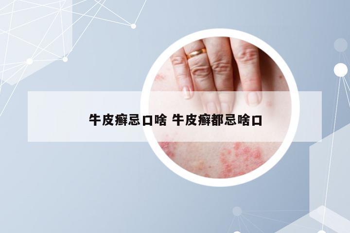 牛皮癣忌口啥 牛皮癣都忌啥口